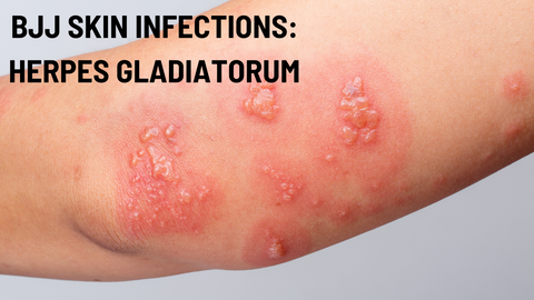 BJJ and Grappling Skin Infections Part 3: Herpes Gladiatorum